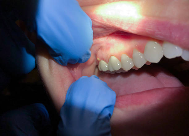 Best Tooth Infection Emergency Dentist  in Muse, PA